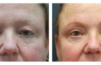 Man before and after eyelid surgery