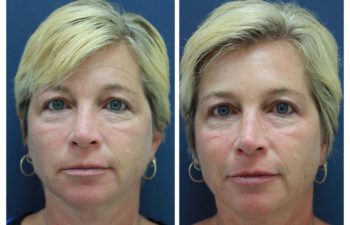 Botox before and after