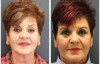 Face Neck Lift before and after