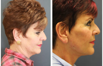 Face Neck Lift before and after