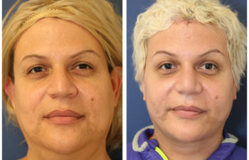 Woman before and after nose surgery