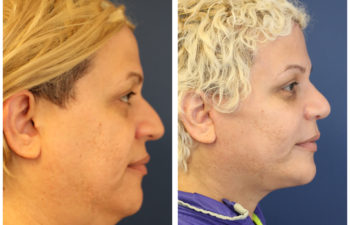 Woman before and after nose surgery