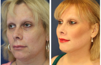 Woman before and after nose surgery
