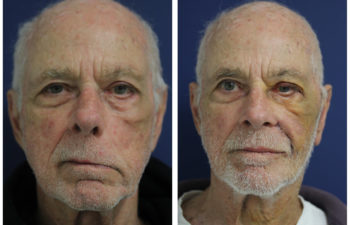 Male before and after facial stretching