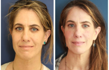 Fillers - before and after