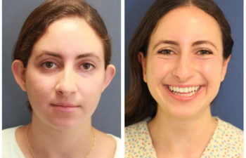 Young girl before and after nose surgery