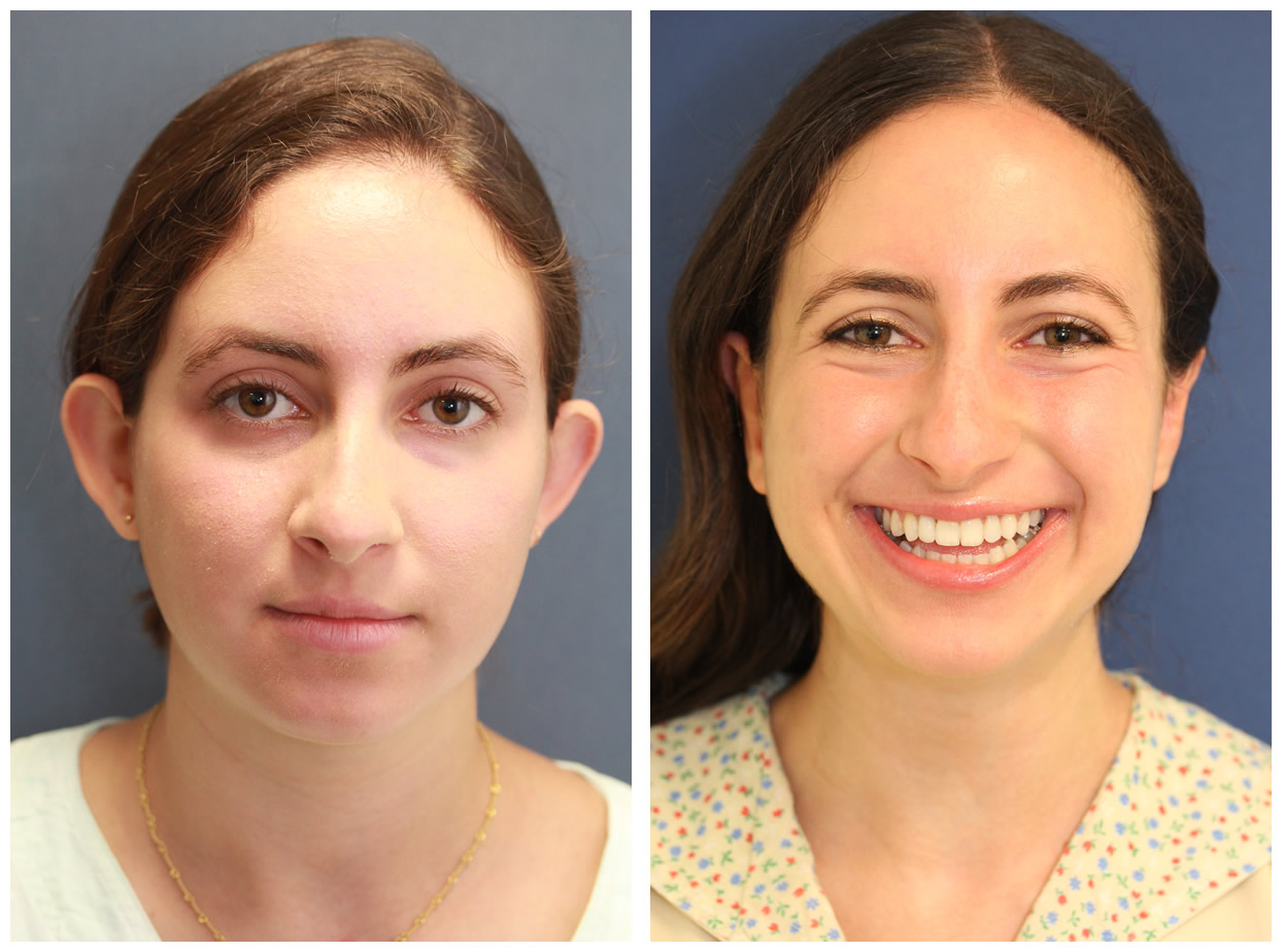 NYC Otoplasty Cosmetic Ear Surgery Before And After Pictures Upper.