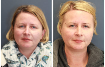 Woman before and after nose surgery