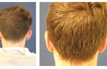 Boy before and after ear surgery