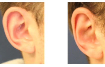 Boy before and after ear surgery