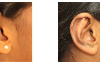 Young girl before and after ear surgery