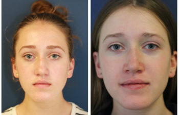 Young girl before and after nose surgery