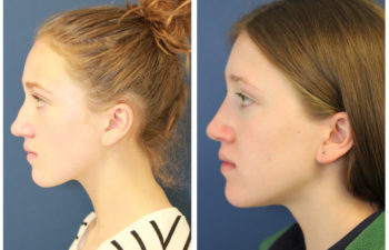 Young girl before and after nose surgery