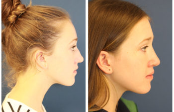 Young girl before and after nose surgery