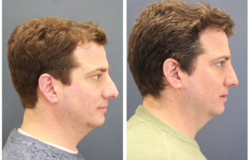 Young man before and after nose surgery