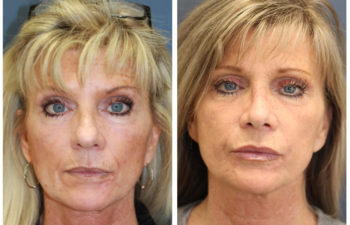 Woman before and after nose surgery