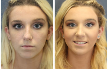 Girl before and after nose surgery