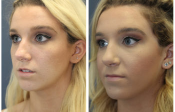 Girl before and after nose surgery