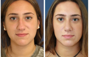 Girl before and after nose surgery