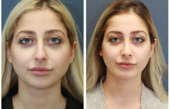 Girl before and after nose surgery
