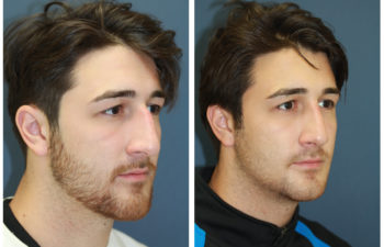 Young man before and after nose surgery