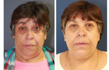 Woman before and after Selective Neurolysis, Directed Nerve Transfer, Face/Neck Lift