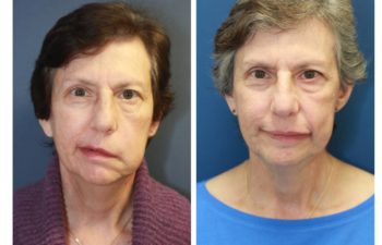 Woman before and after Comprehensive Facial Reanimation