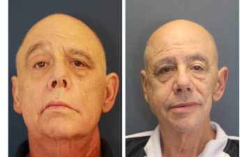Male before and after Comprehensive Reanimation after Head and Neck Cancer