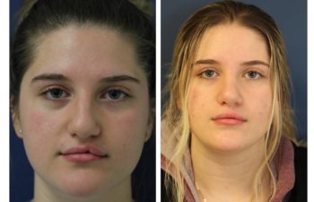Woman before and after nose surgery