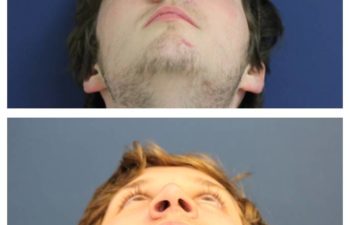 Man before and after nose surgery