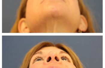 Face Naeck Lift before and after