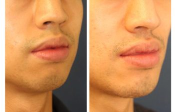 Male patient before and after facial implant surgery
