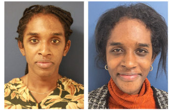 Woman before and after rhinoplasty