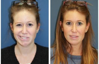 Patient before and after cranial nerve 5-7 transfer