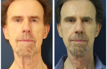 Man before and after facelift