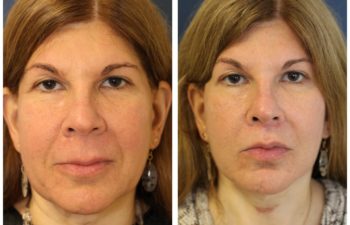 Woman before and after facelift