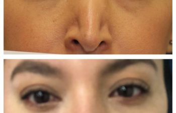 Woman before and after revision rhinoplasty