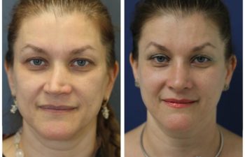 Woman before and after revision rhinoplasty