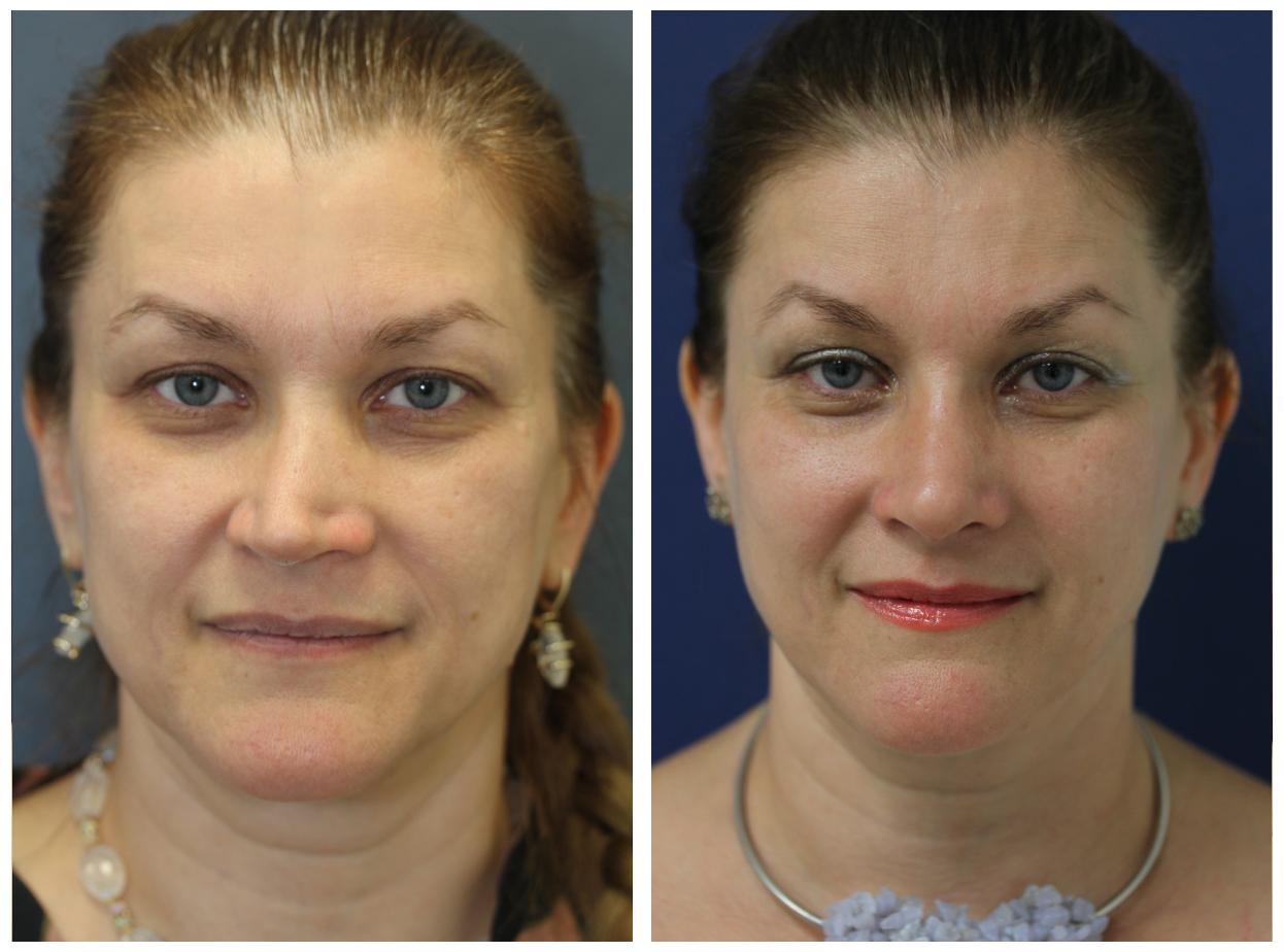 NYC Revision Rhinoplasty Before and After Pictures | Upper East Side