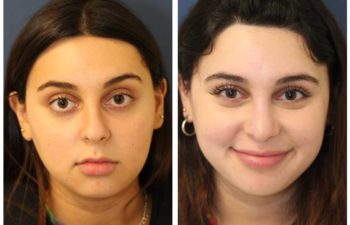 Woman before and after rhinoplasty