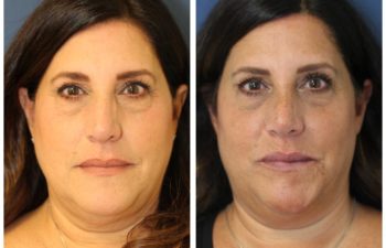 Woman before and after rhinoplasty