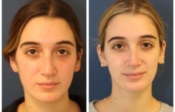 Woman before and after rhinoplasty