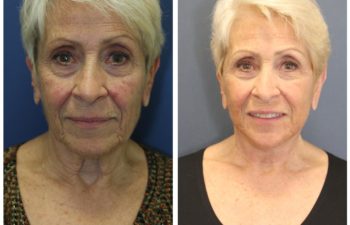 Woman before and after facelift
