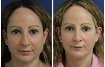 Woman before and after rhinoplasty