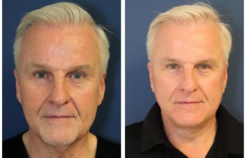 Man before and after facelift
