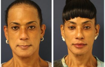 Patient before and after facial feminization