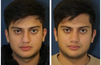 Man before and after rhinoplasty