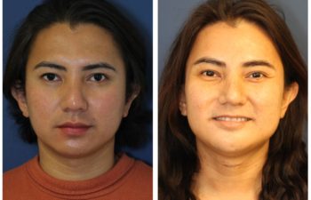 Patient before and after facial feminization