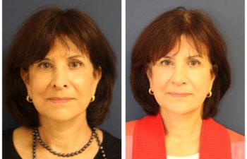 Woman before and after revision rhinoplasty