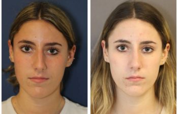Woman before and after rhinoplasty